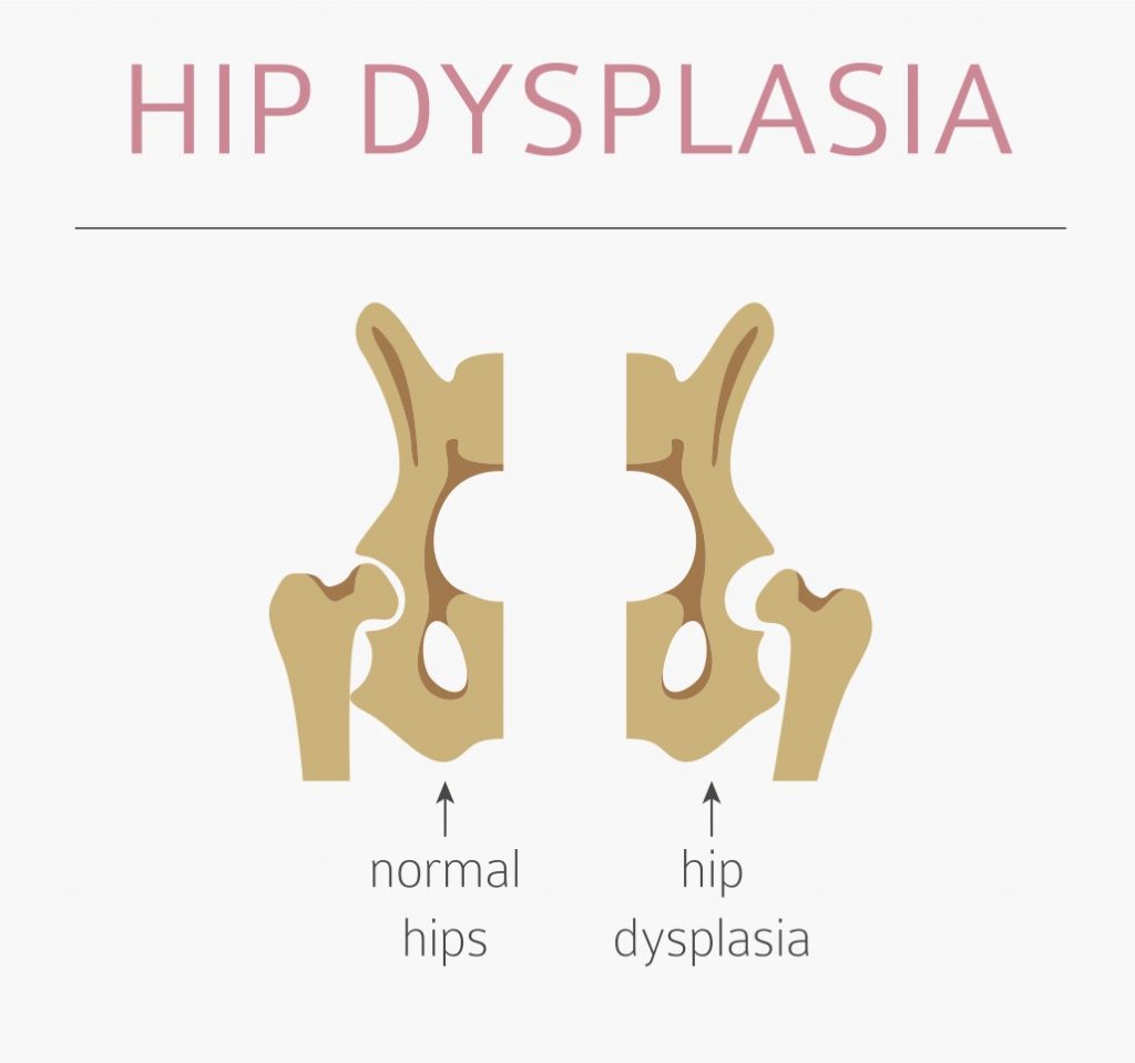 Heartwarming Tips About How To Detect Hip Dysplasia - Blockbath71